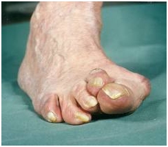reuma voet voorbeeld